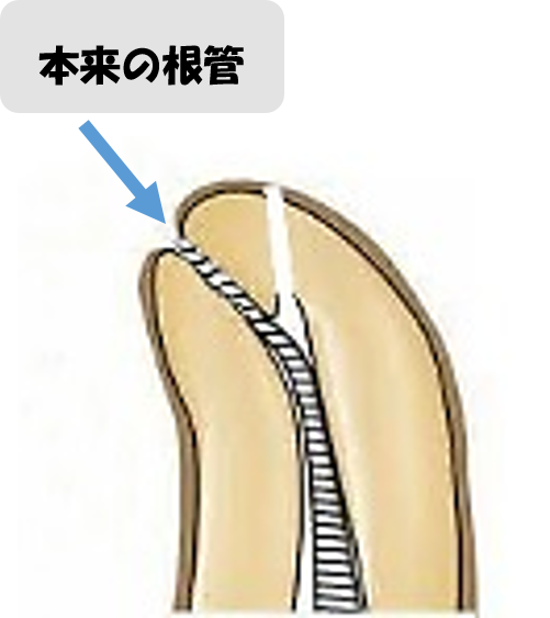 レッジ パーフォレーション - まるかわ歯科医院（千歳烏山駅）
