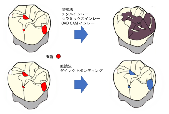 ダイレクトボンディング法 コンポジットレジン充填 - まるかわ歯科医院