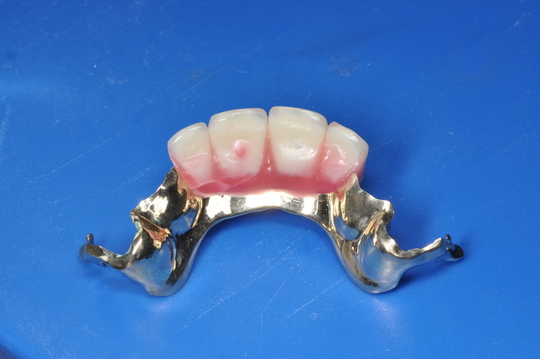 義歯　入れ歯　見本 精密義歯（入れ歯） | 枚方市楠葉・枚方くずはアップル歯科